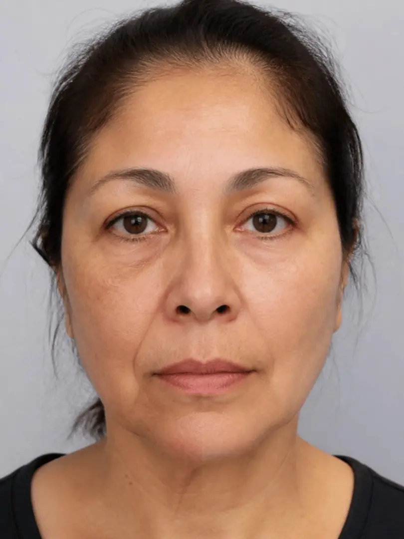 Imagen ilustrativa: rostro antes de hilos tensores