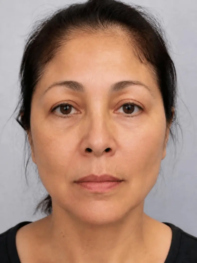 Imagen ilustrativa: rostro con lifting de hilos tensores