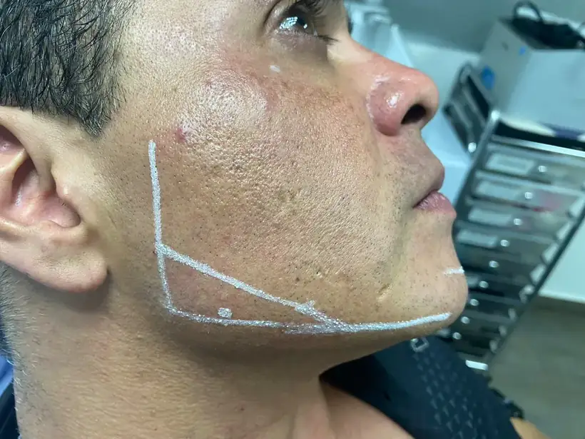 Marcaje para perfilamiento mandibular con ácido hialurónico